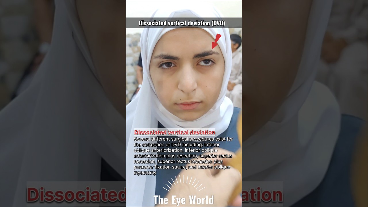 Dissociated vertical deviation (DVD) #eyes #ophthalmology #the_eye_world #strabismus #youtubeshorts