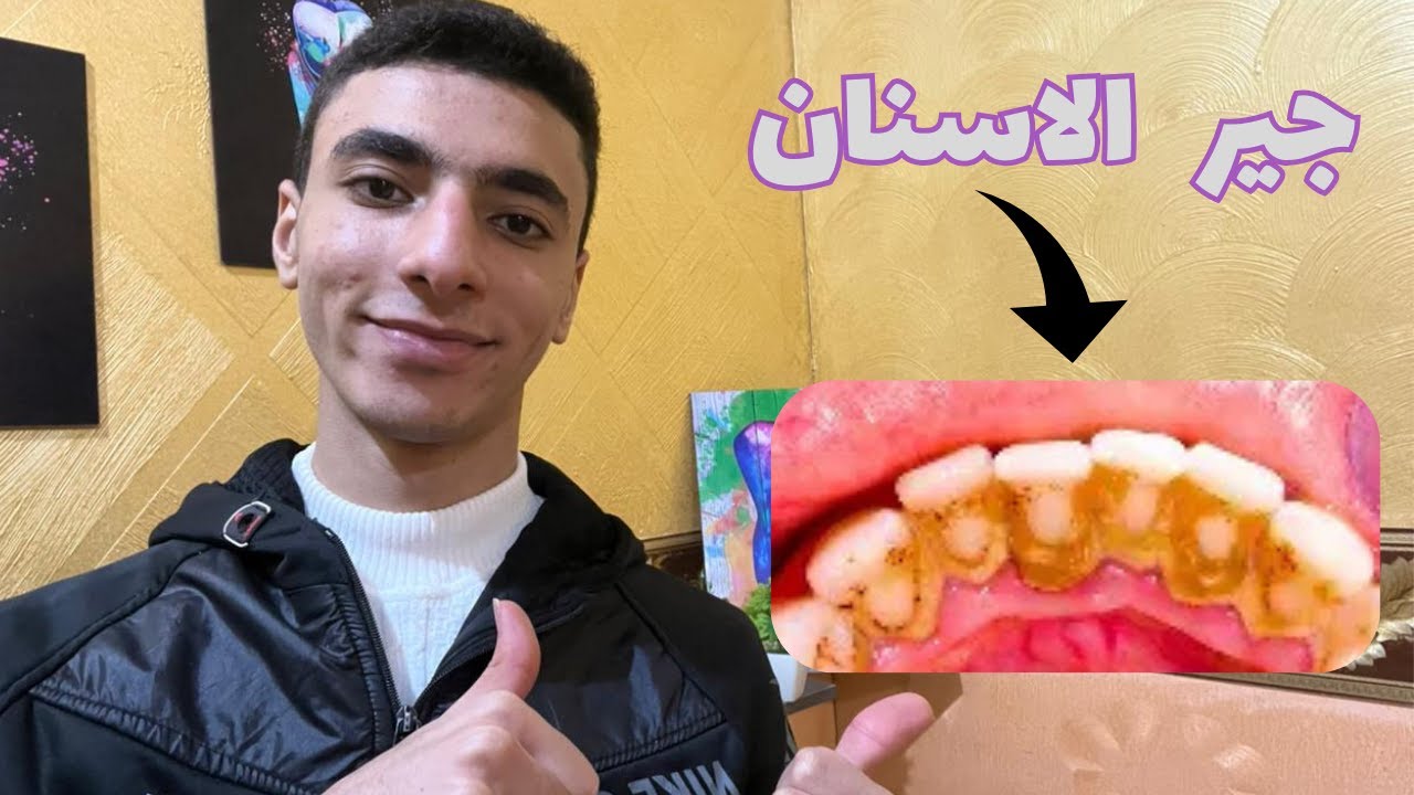  جير الأسنان اسبابه وعلاجه 👌