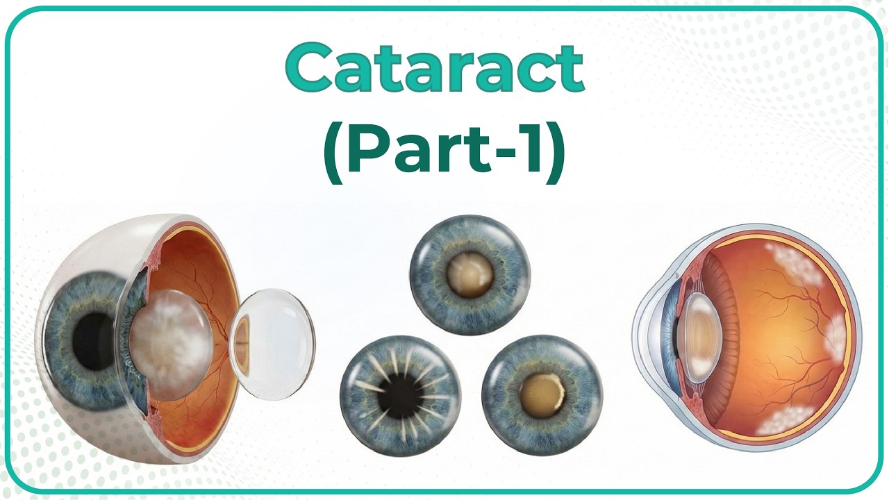 5. Катаракта 👁️ Введение, типы, локализация и структурная классификация (Часть 1)