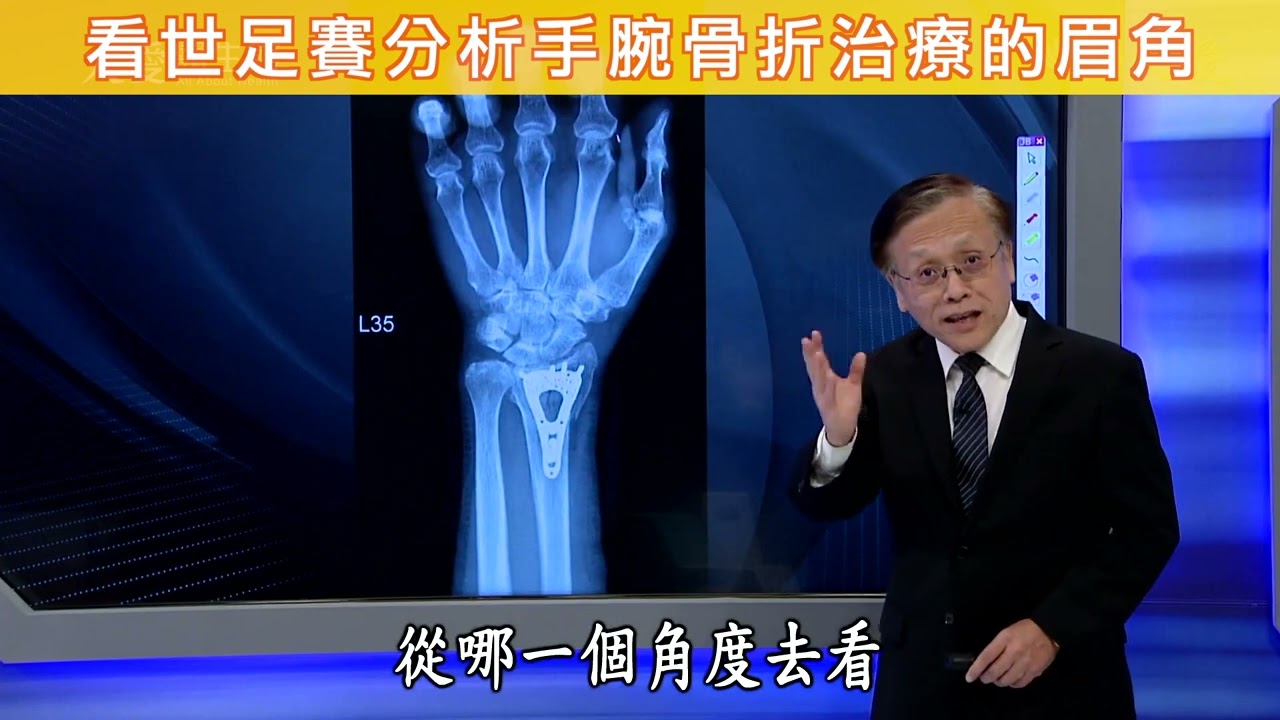 【看世足賽分析手腕骨折治療的眉角】【大愛醫生館精選】
