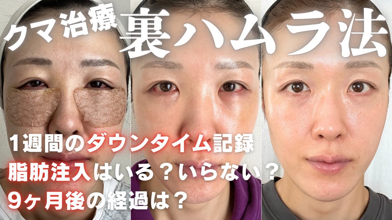 【裏ハムラ】８日間のダウンタイムの記録👁️🌟脂肪注入は必要？9ヶ月後の今は？の結果は...