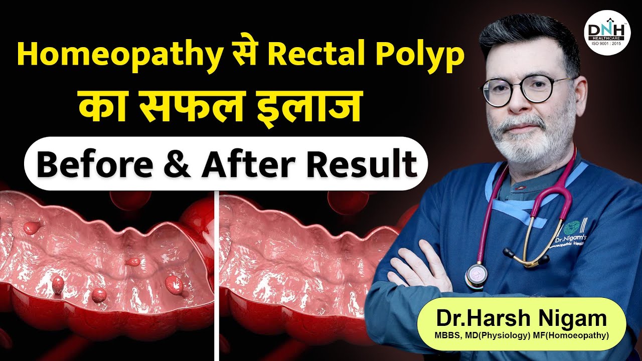 Homeopathy से Rectal Polyp का सफल इलाज | Before & After Result