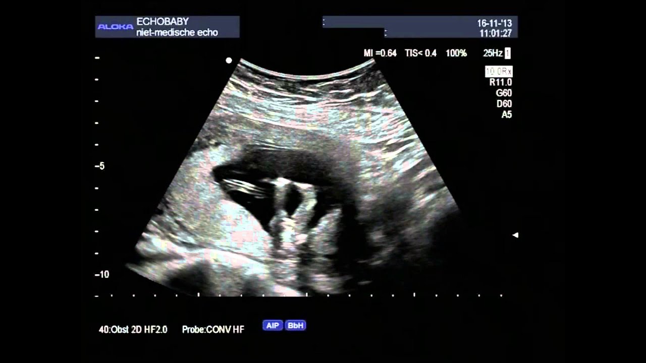 2D-echo 13 weken een meisje, met ingesproken uitleg