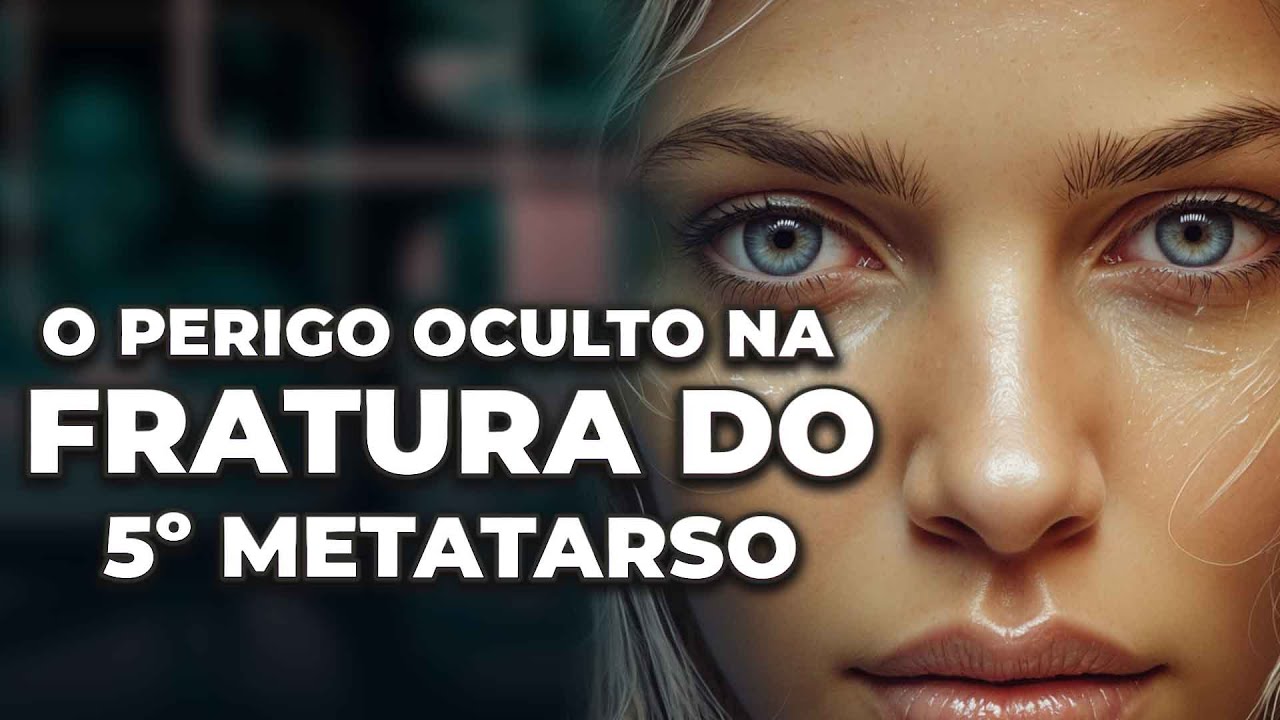 O RISCO DAS FRATURAS NO 5 METATARSO