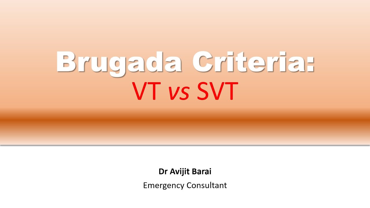 Brugada criteria:  How to differentiate VT from SVT