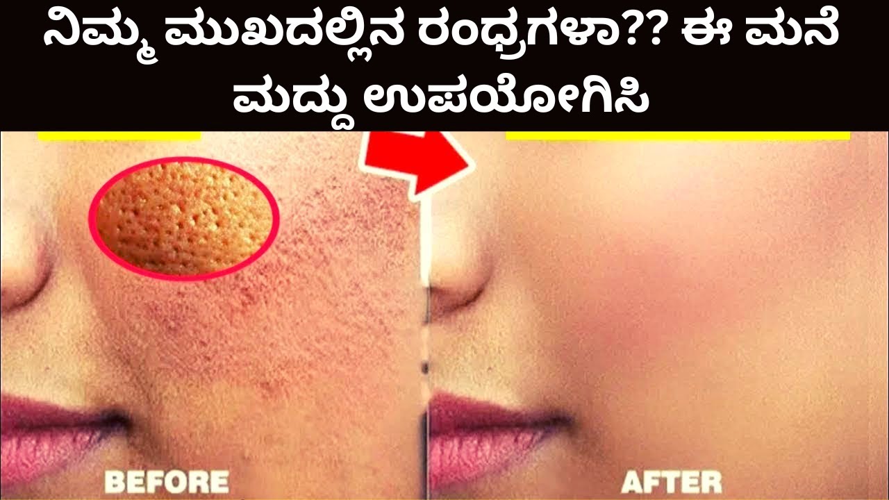 ನಿಮ್ಮ ಮುಖದಲ್ಲಿನ ರಂಧ್ರಗಳಾ?? ಈ ಮನೆ ಮದ್ದು ಉಪಯೋಗಿಸಿ । Open pores Home remedy
