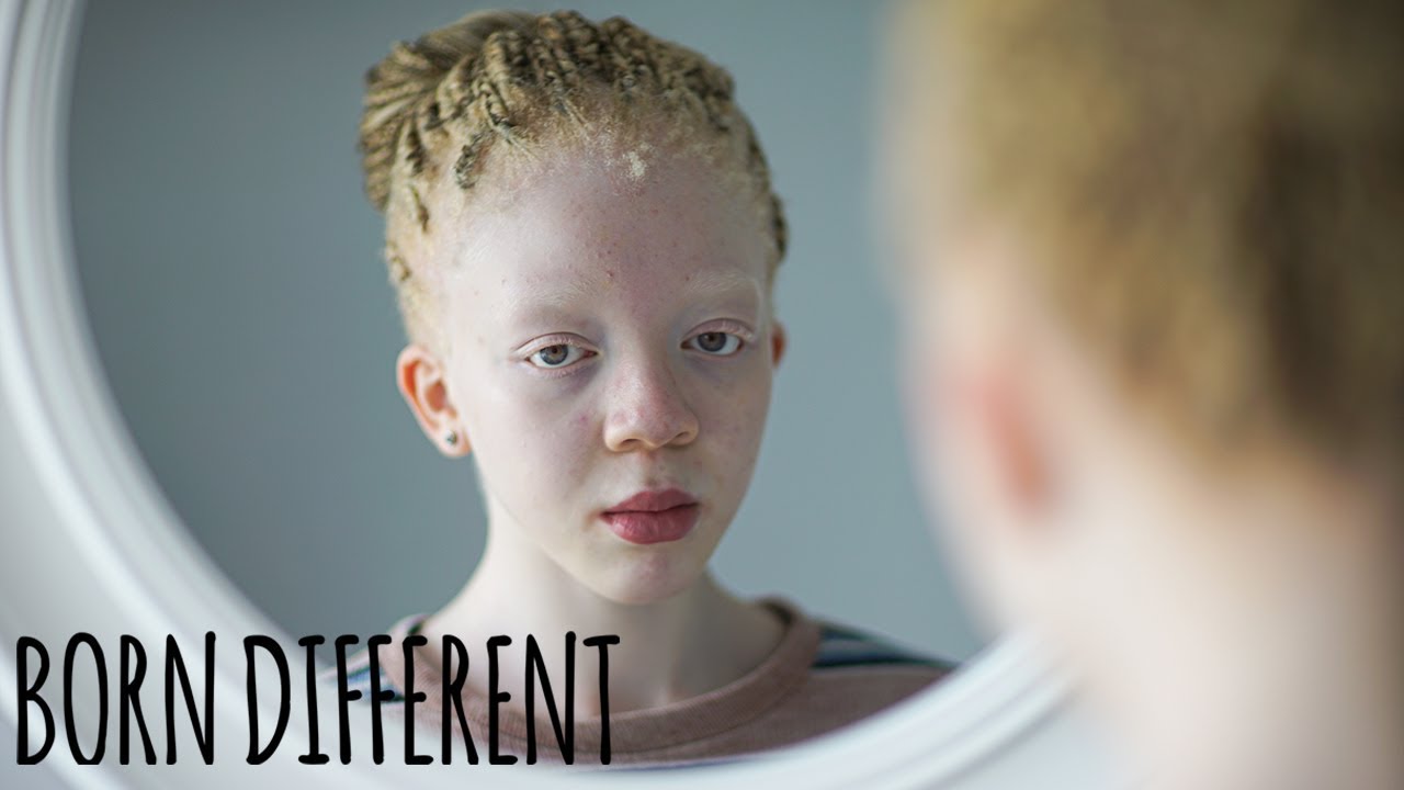 I&rsquo;m Black, Even With Albinism | BORN DIFFERENT