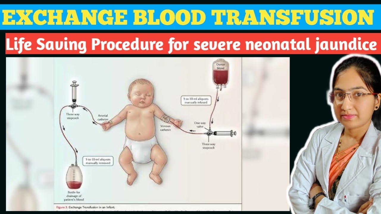 Life Saving Prcedure For Neonatal Jaundice | Exchange Blood Transfusion In Newborn | Treatment
