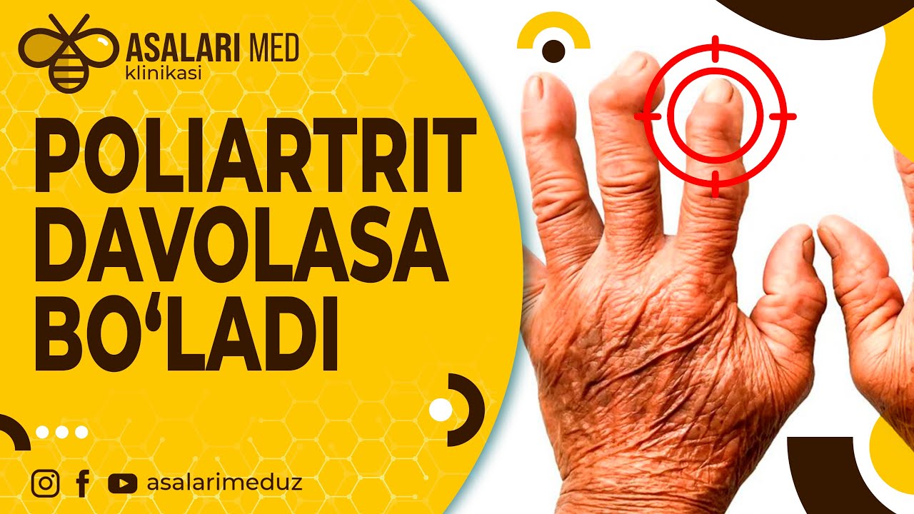 Полиартритнинг 100 %табиий ва ишончли давоси. #asalarimed  #poliartrit  #artrit