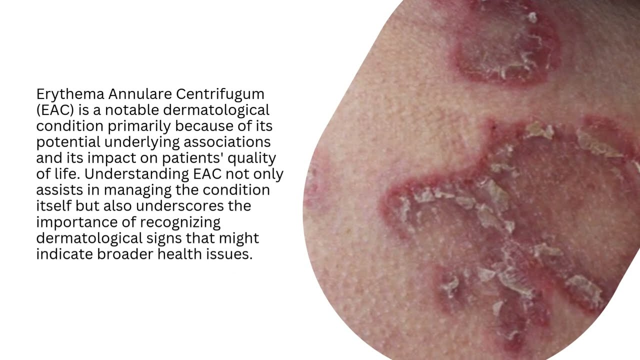 Erythema Annulare Centrifugum (EAC)