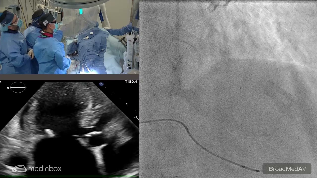 Alcohol Septal Ablation To A Patient With HOCM And MR
