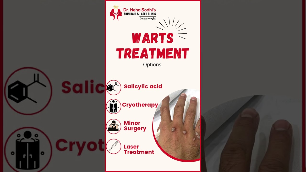 WARTS  Treatment