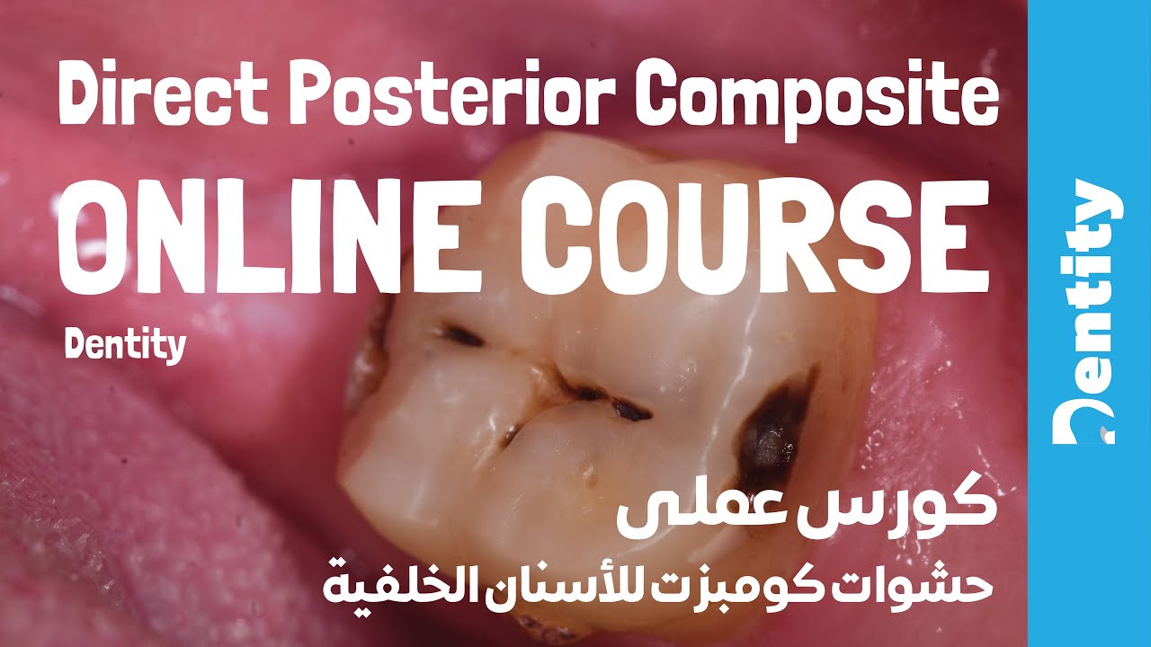 Direct Posterior Composite – Clinical [ 2021] | حشوات الأسنان الخلفية