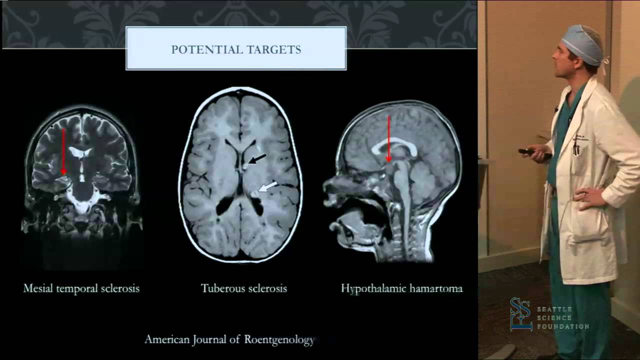 MRI Guided Focused Ultrasound in Neurosurgery by Stephen Monteith MD, PhD
