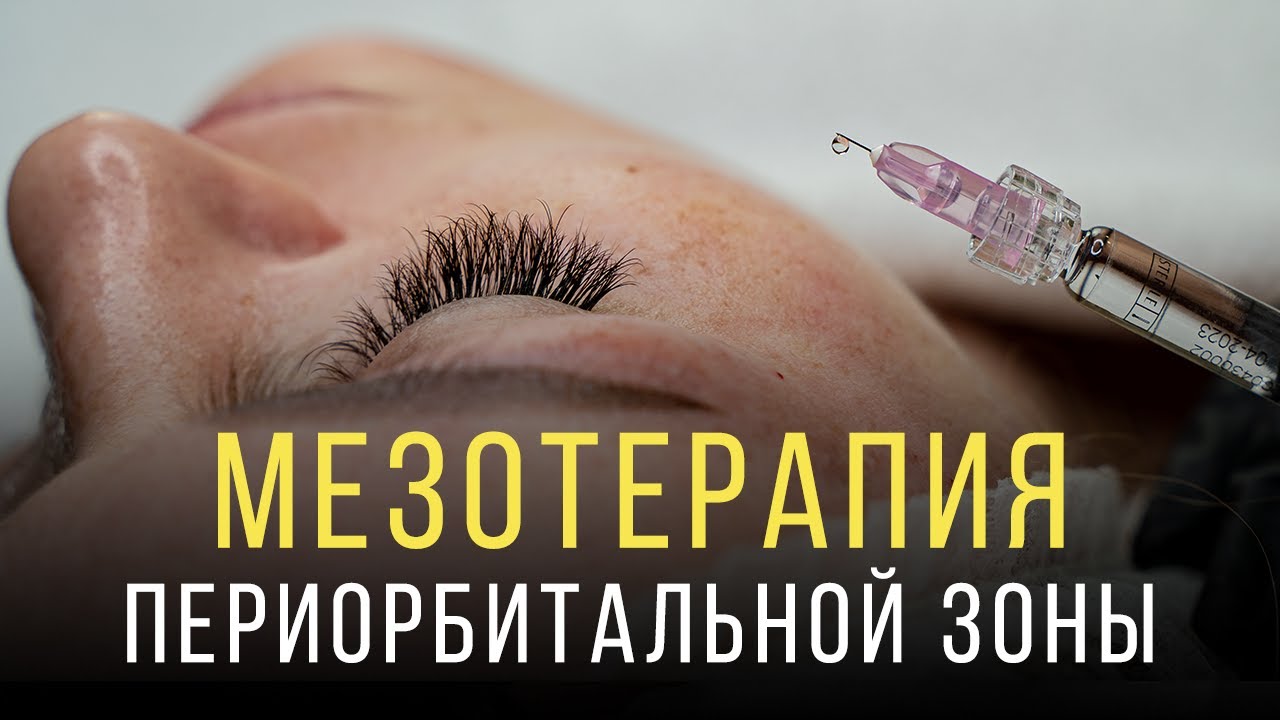 Мезотерапия вокруг глаз💉