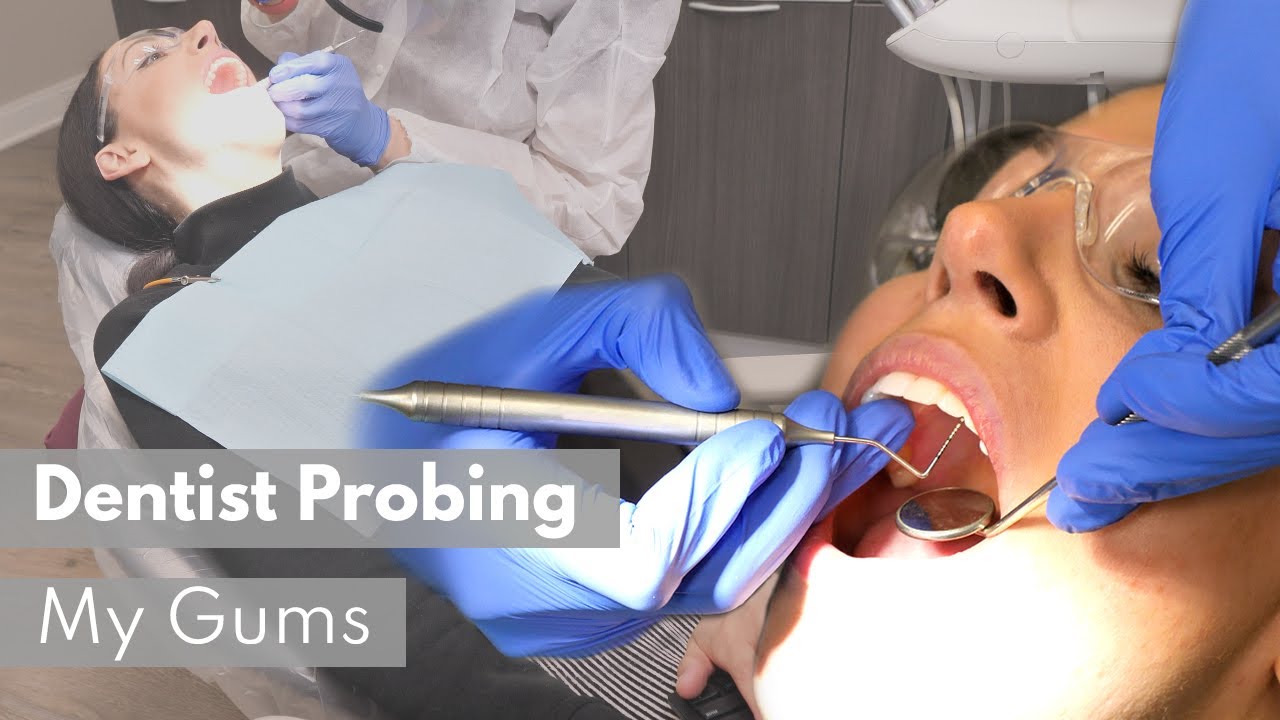 Dentist Probing My Gums (Perio Charting, Gingival Measurements)