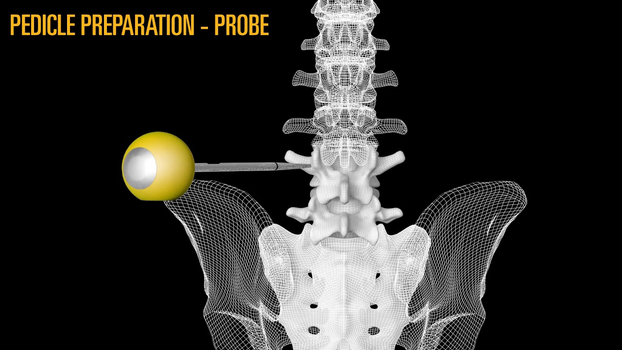 CoreLink Tiger Pedicle Screw System