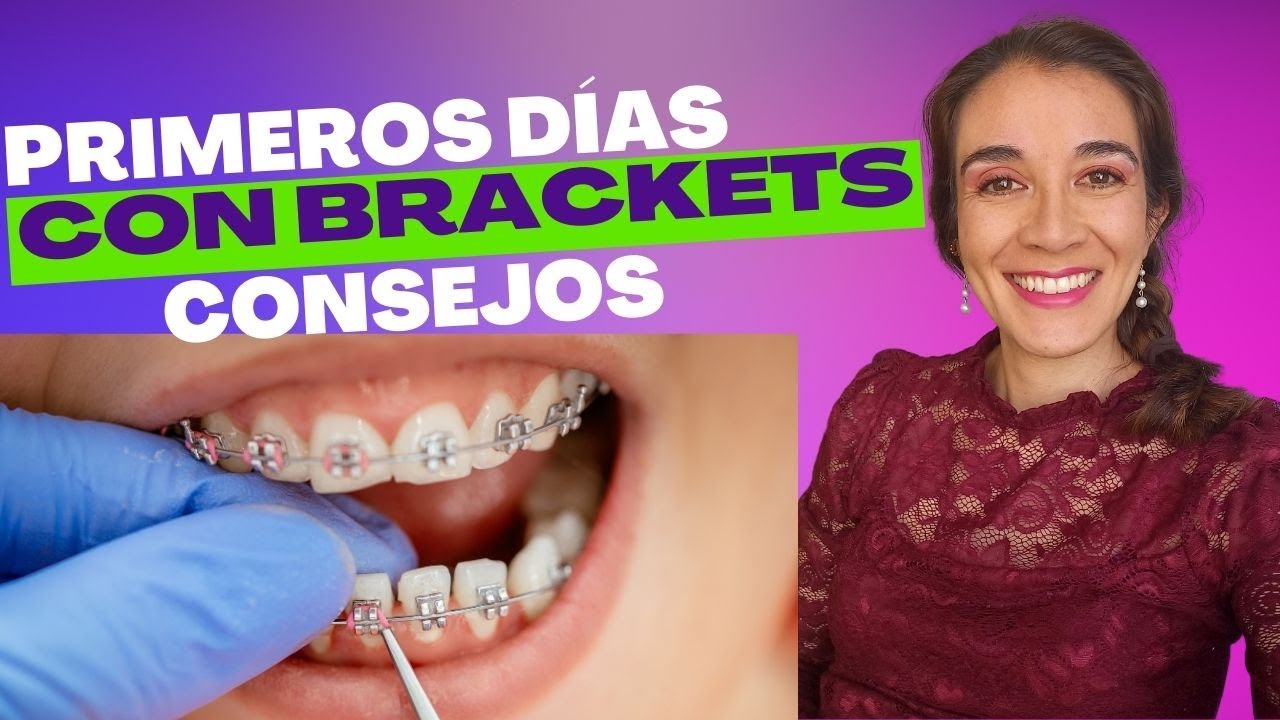 Consejos para los Primero Días con BRACKETS