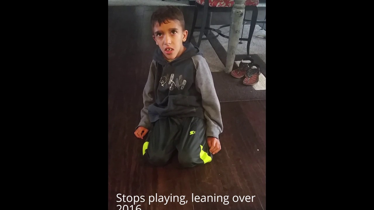 Mowat Wilson Syndrome: Brady having a decline in his condition at age 10