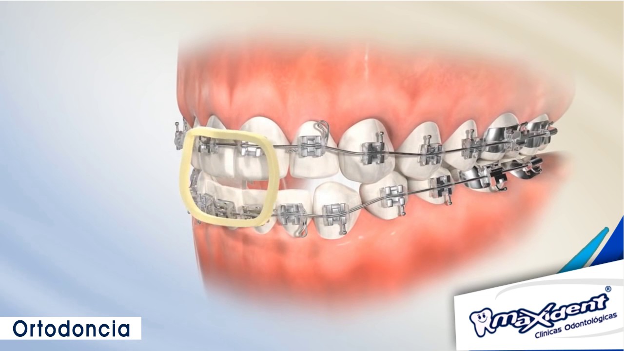 Corrección de mordida y espacios dentales 