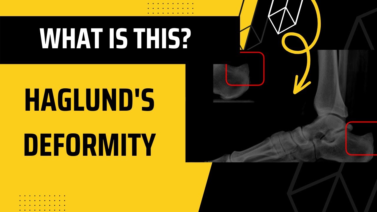 Haglund's deformity?? Check this out!