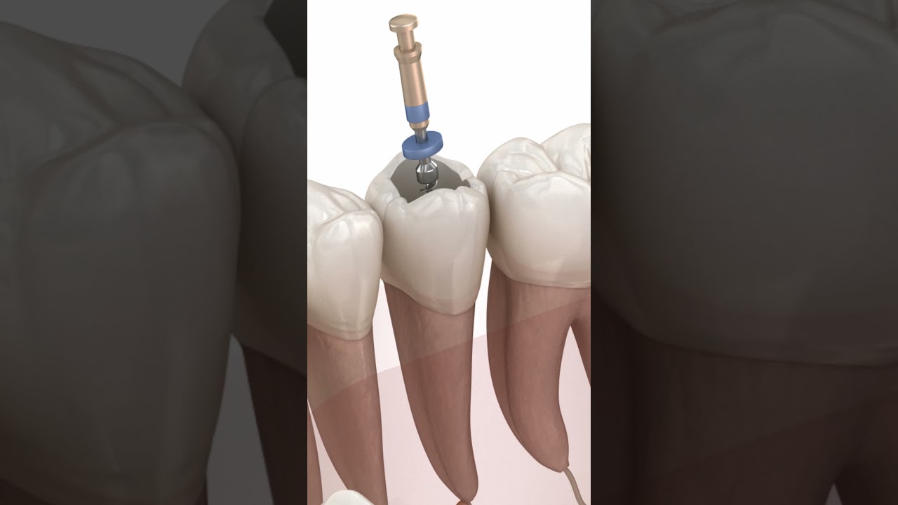 Kanal Tedavisi Tek Seferde Biter mi? #drfeyyaz #periodonta  #kanaltedavisi