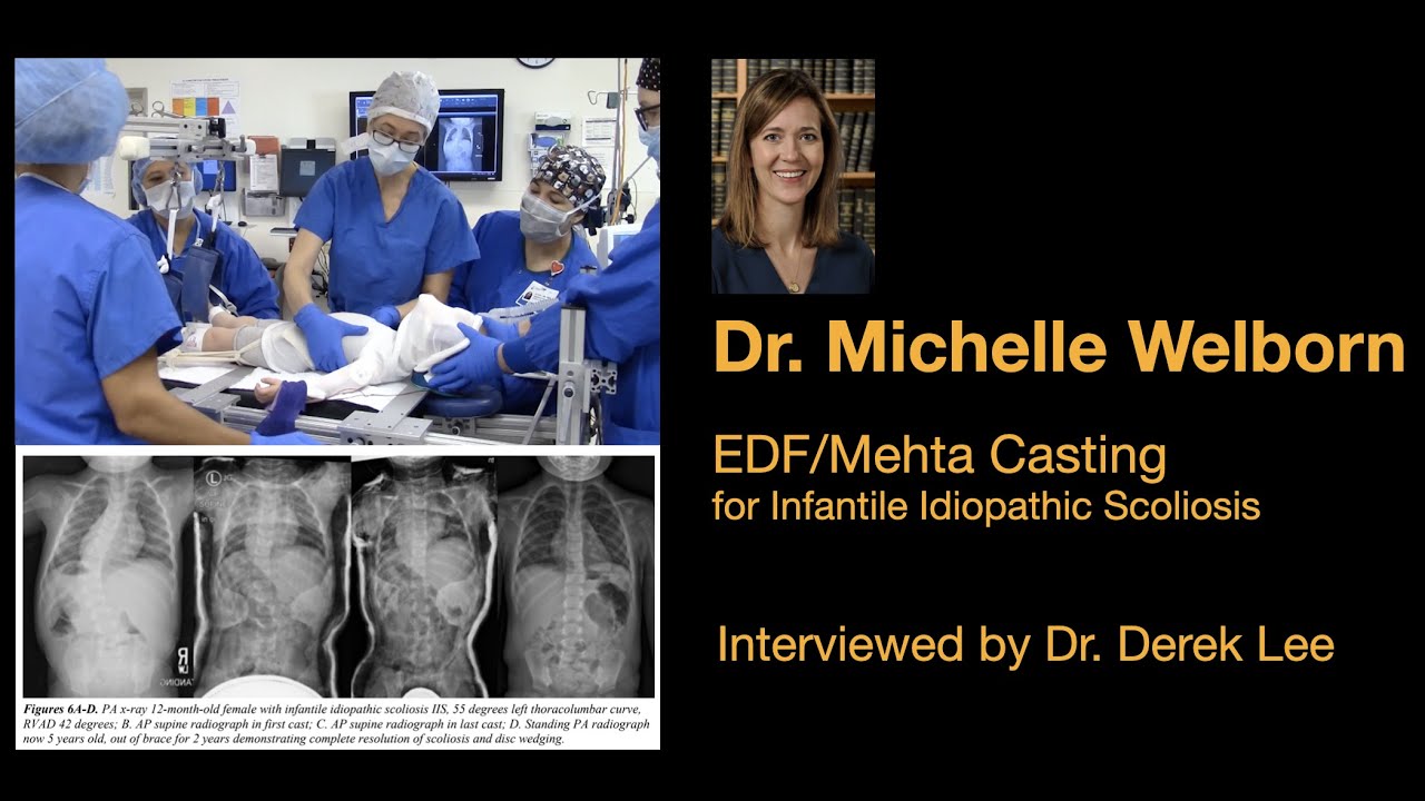 Dr. Michelle Welborn, EDF/Mehta Casting for Infantile Idiopathic Scoliosis, with Dr. Derek Lee