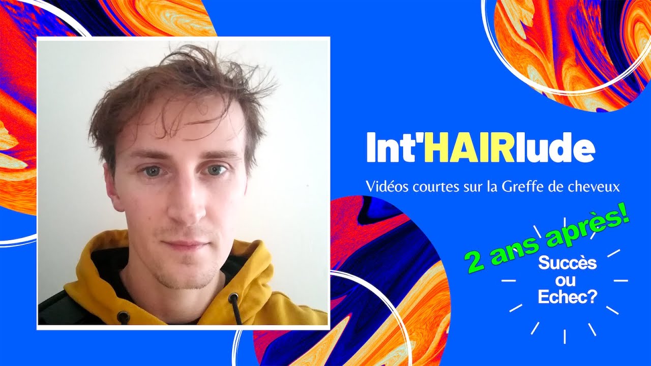 2 ans après Ma greffe FUE est elle réussie?