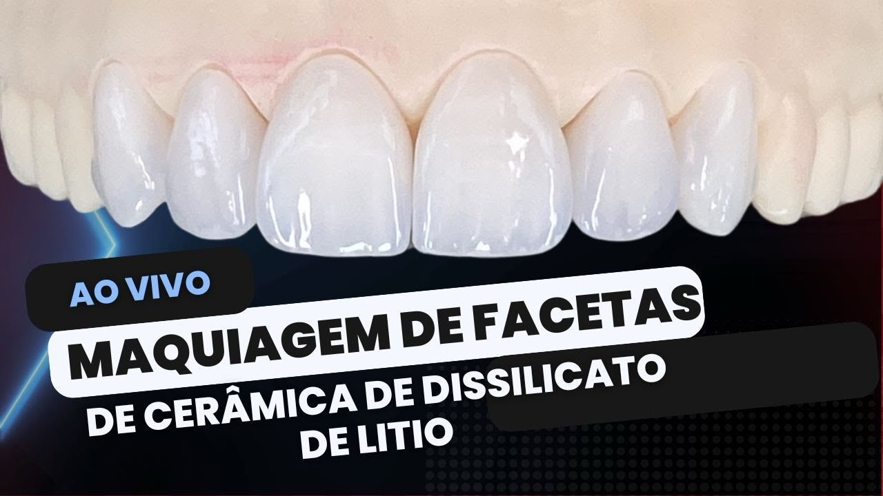 Facetas de Ceramica de Dissilicato de Litio