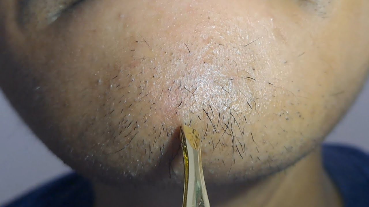 Satisfying, kegiatan rutin cabut bulu jenggot #13 #satisfying #hairremoval 