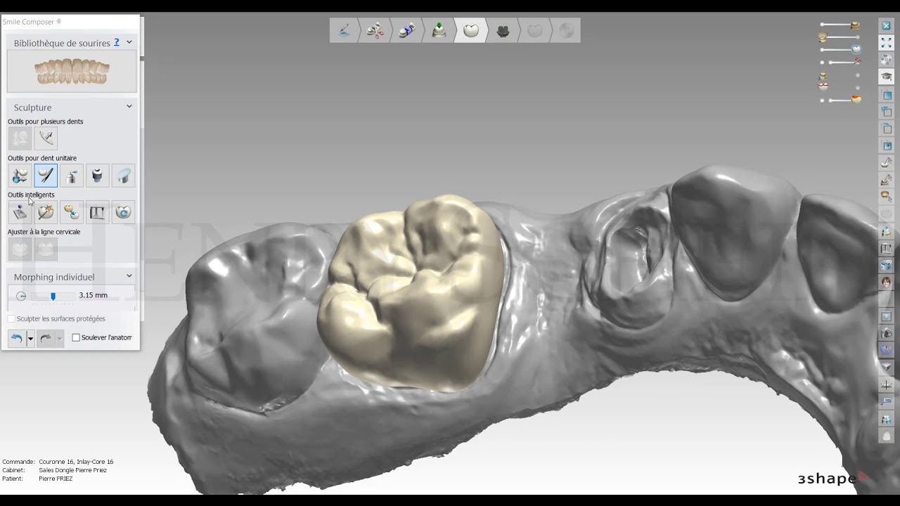 Inlaycore avec 3Shape