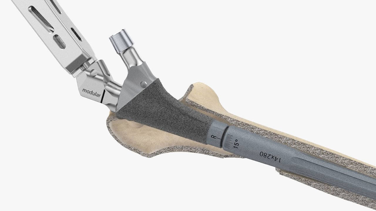 AESCULAP&reg; Prevision&reg; Monobloc & Modular Revision Hip Stem System - Surgical Technique