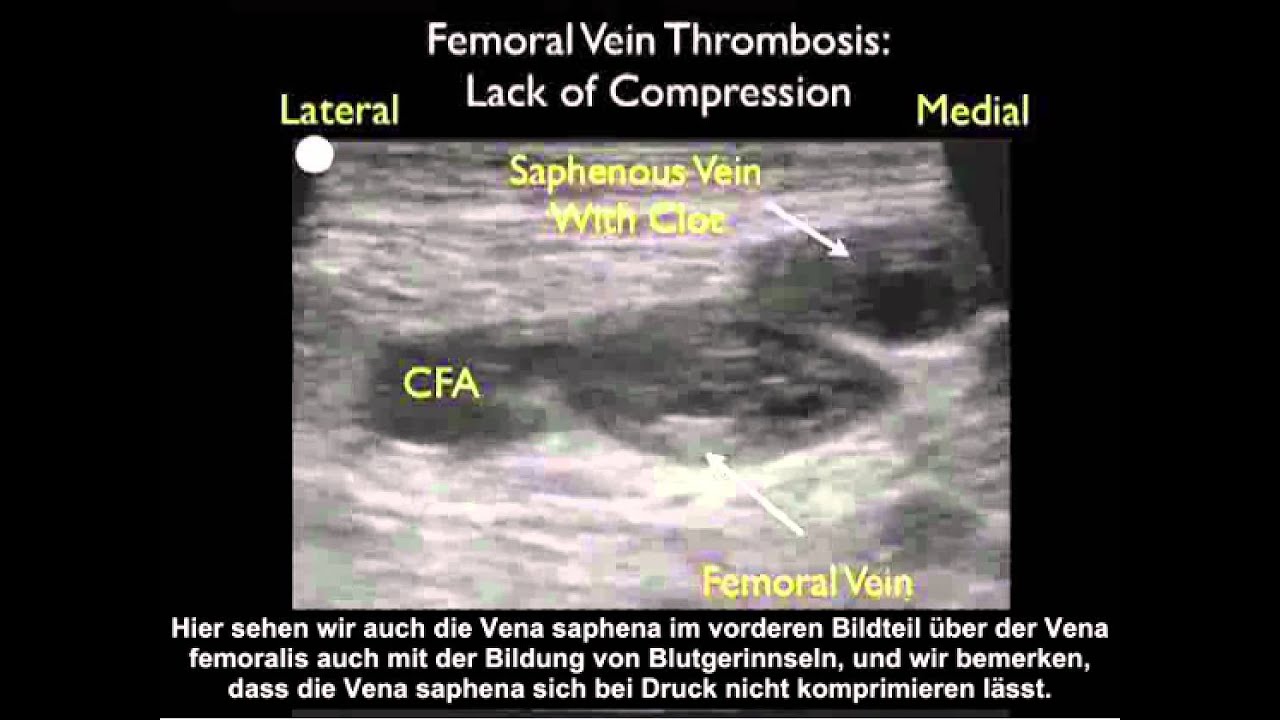 Anleitung: Fallstudie – Ermittlung einer tiefen Venenthrombose mit Ultraschall – Teil 2