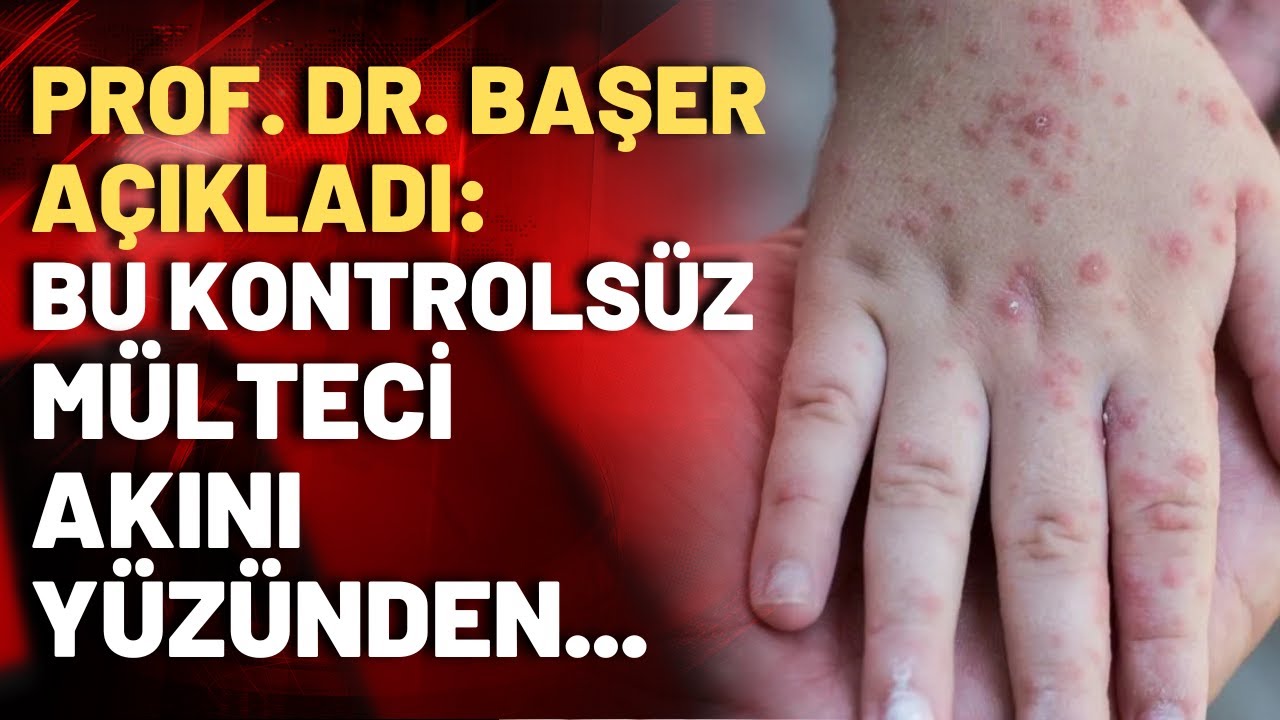 Kızamık salgını için kırmızı alarm! Kovid'den sonra ikinci dalga mı geliyor?