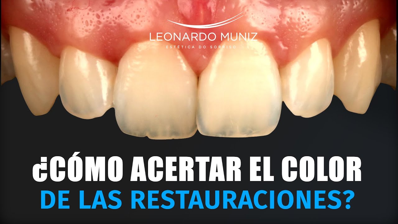 ¿Cómo acertar el color de las restauraciones?