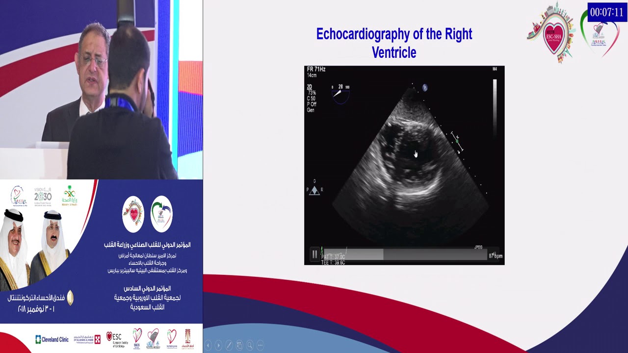 Osama Abdelraouf   Evaluation of RV Function by TEE