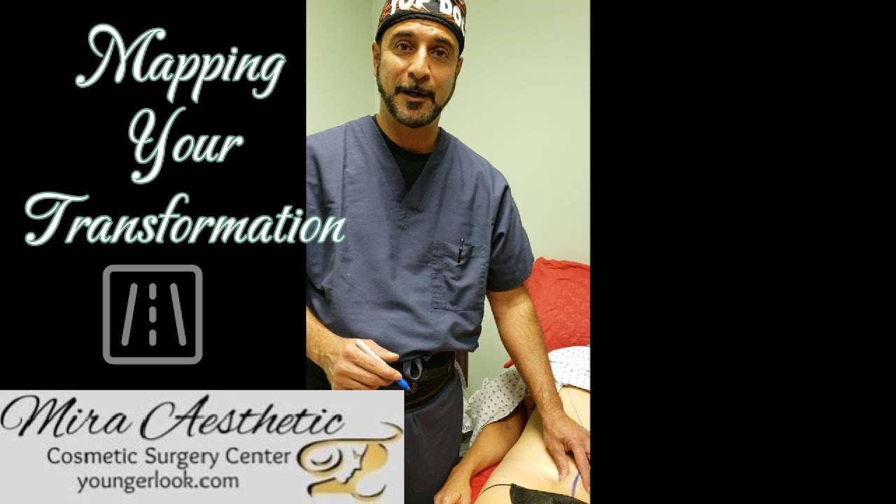 Step by Step Tummy Tuck Drawing   Visual Guide to the Procedure