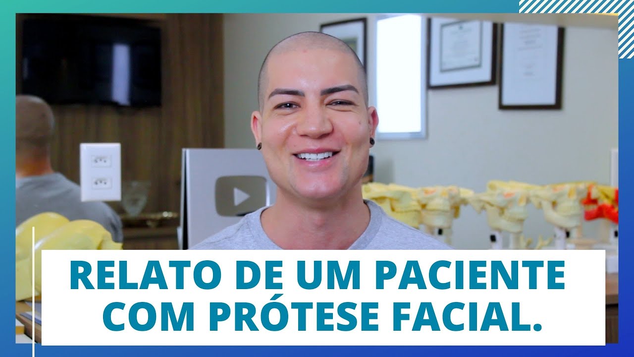 Harmonização Facial Definitiva - Prótese Facial  -  Depoimento de quem Fez