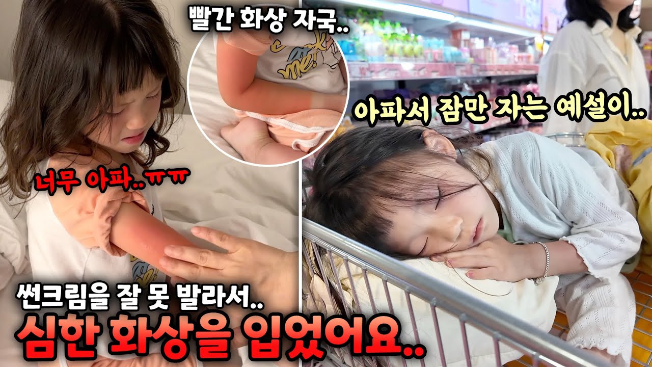 살이 탄지도 모르고 수영하다가 화상을 심하게 입은 예설이..많이 아픈지 계속 누워있어요..ㅠㅠ