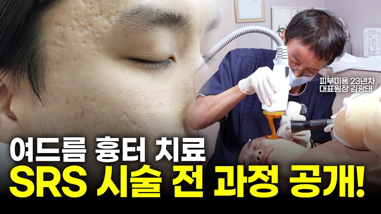 여드름 흉터 치료 전 과정! SRS 레이저 시술 리얼 후기 | 여드름흉터 SRS레이저 효과 통증