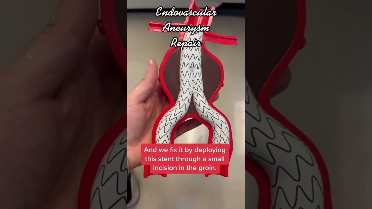 Repairing an abdominal aortic aneurysm with a stent