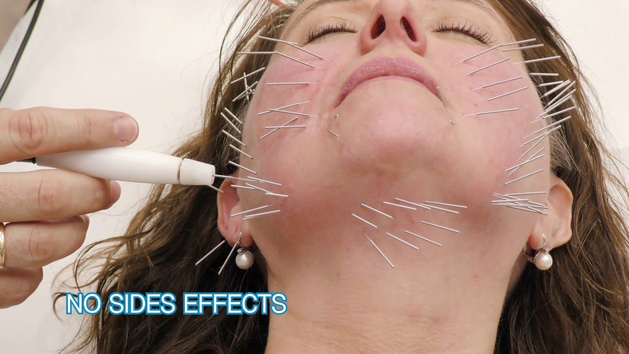 Needle Shaping