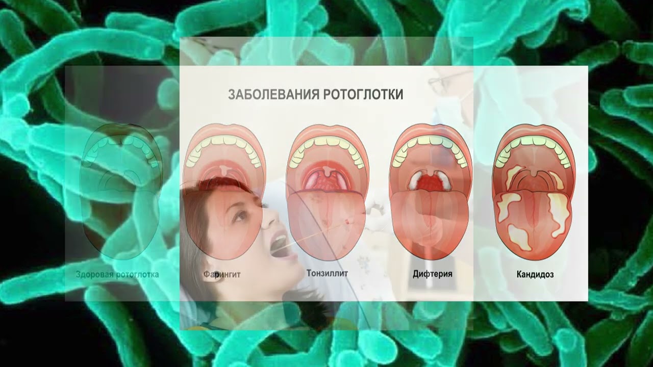 О дифтерии...