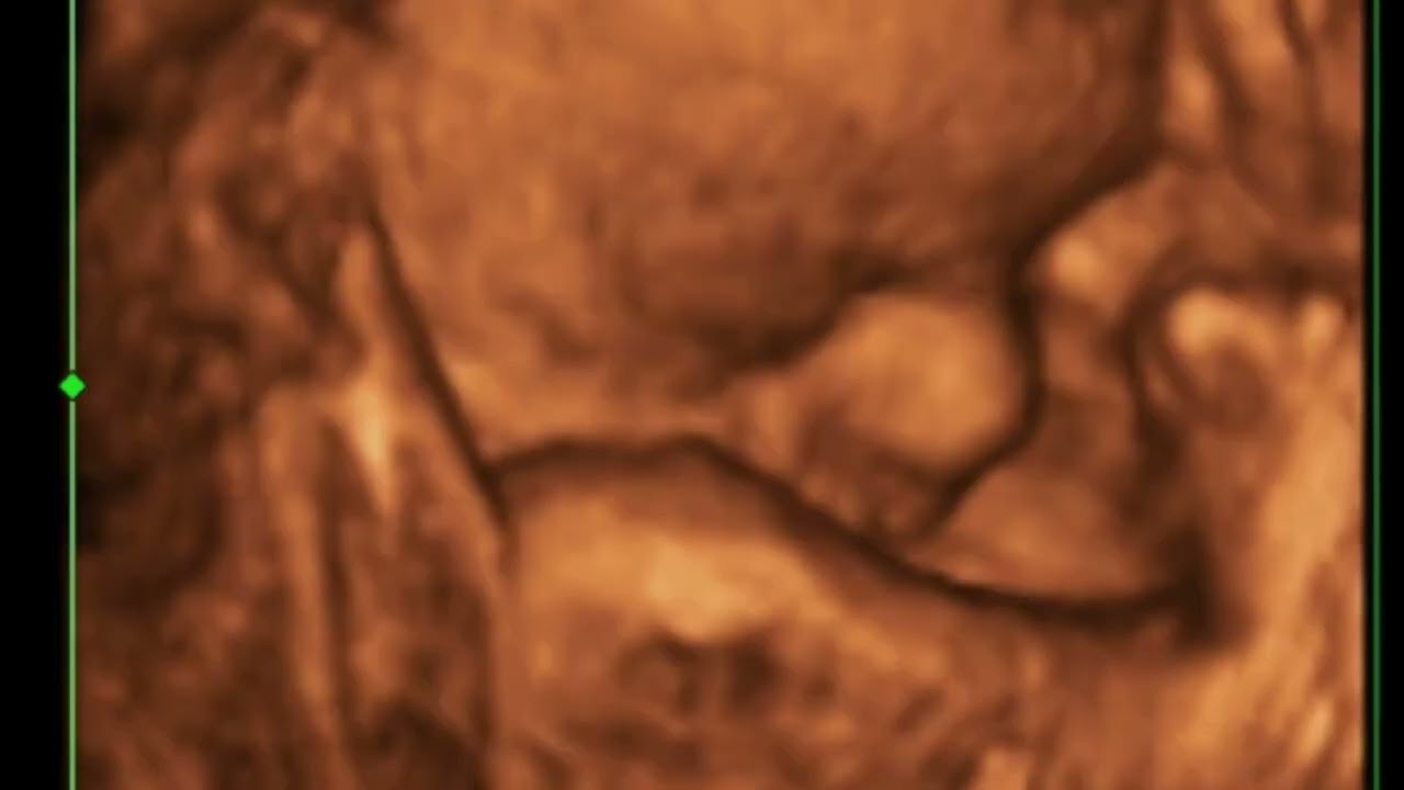 34 Weeks 3D/4D Ultrasound