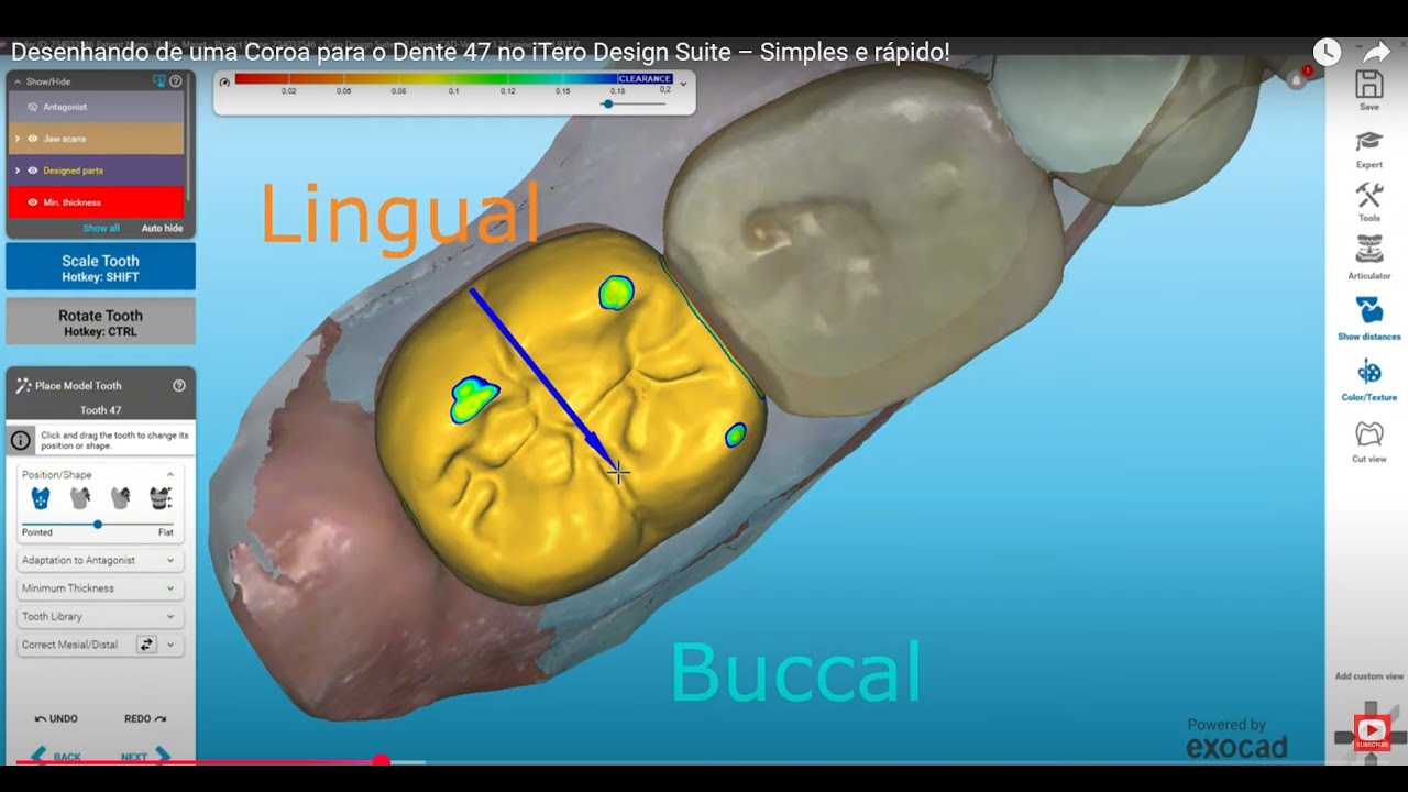 Designing a Crown for Tooth 47 in iTero Design Suite – Simple and Fast!