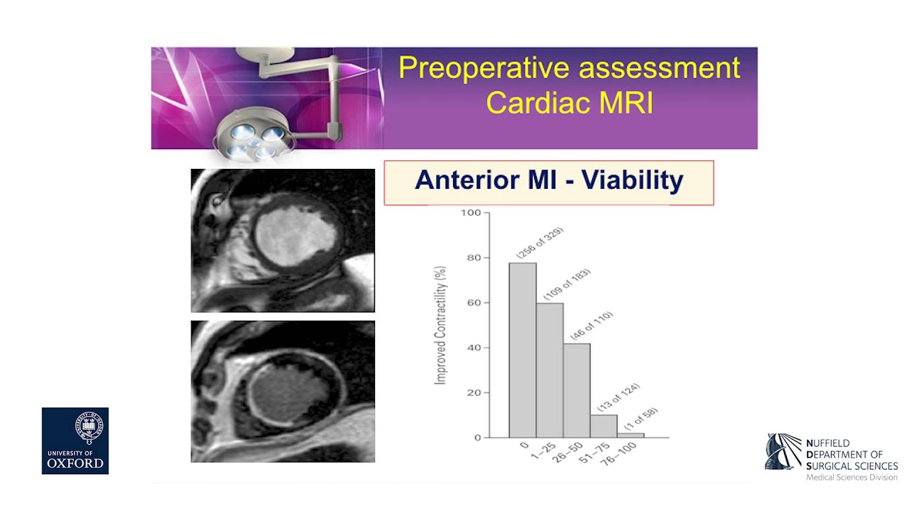 Oxford University surgical lectures: coronary artery bypass graft surgery