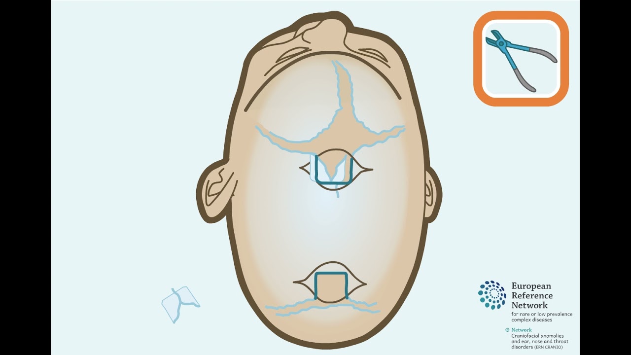 Endoscopically assisted suturectomy for scaphocephaly