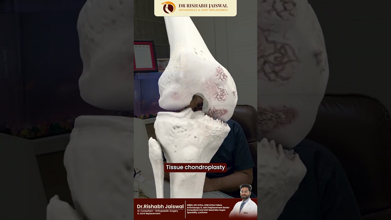 Arthritis Knee Pain Treatment Explained | When Surgery Is the Right Option PART 6