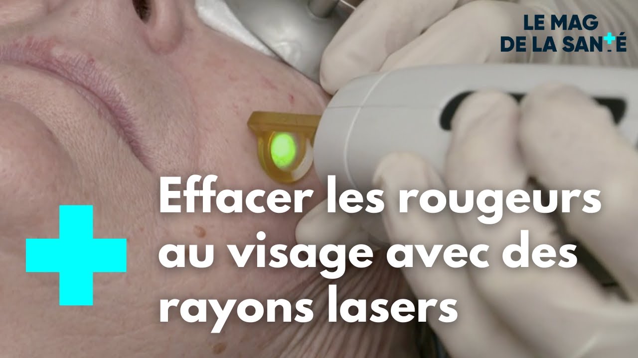Couperose : s'en débarrasser grâce au laser vasculaire - Le Magazine de la Santé