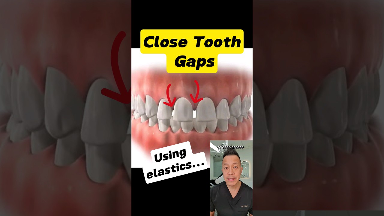 Using Elastics: How Braces Elastics Close Tooth Gaps! #shorts #dentallan #dentist